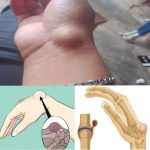 Wrist Ganglion: Causes, Symptoms, and Effective Treatments.