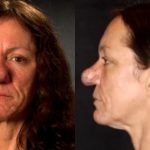 Now she is unrecognizable!>> The surgeons gave this woman with strange nose a completely different face