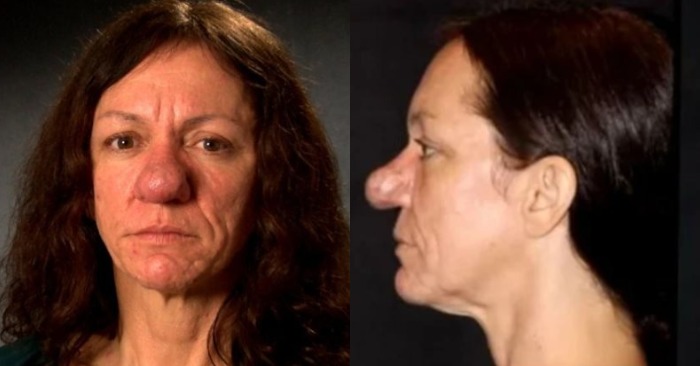 Now she is unrecognizable!>> The surgeons gave this woman with strange nose a completely different face