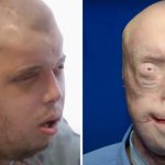 Firefighter suffers third-degree burns – this is him 7 years later