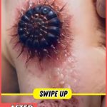 Acne And Everything You Need To Know About Them