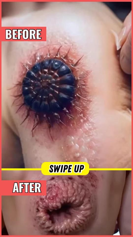 Acne And Everything You Need To Know About Them