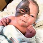 Mom on a mission to show daughter with extremely rare birthmark that she is beautiful