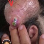 Tracking the Healing Journey of a Giant Bottomless Back Abscess: A Multi-Visit Follow-Up”