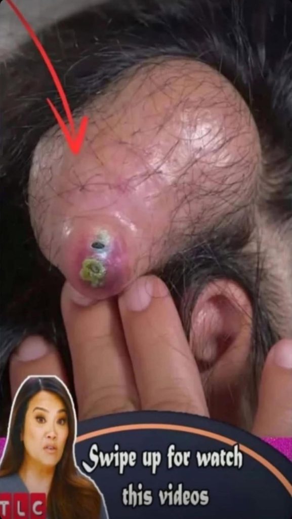 Tracking the Healing Journey of a Giant Bottomless Back Abscess: A Multi-Visit Follow-Upâ