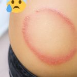 How to identify and cure skin fungus or ringworm.
