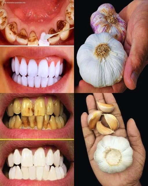 Improve Your Oral Health Naturally with Garlic