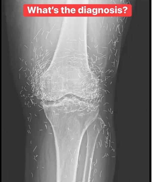 X-Ray Reveals Hundreds of Gold Needles in Woman’s Knees