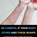 Amazing Causes Of Hives Revealed