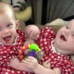 These conjoined twin sisters were born in 2000 and were connected from the chest to the pelvis. They had two torsos but shared internal organs When the girls were seven months old, doctors decided to separate them. The 31-hour surgery was successful, and both sisters survived The most interesting part is that one of the sisters recently became a mother Curious to see how the sisters look 25 years after the separation? Their before/after photos are in the first comment