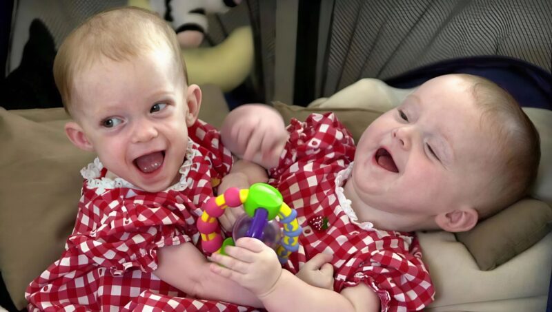 These conjoined twin sisters were born in 2000 and were connected from the chest to the pelvis. They had two torsos but shared internal organs When the girls were seven months old, doctors decided to separate them. The 31-hour surgery was successful, and both sisters survived The most interesting part is that one of the sisters recently became a mother Curious to see how the sisters look 25 years after the separation? Their before/after photos are in the first comment