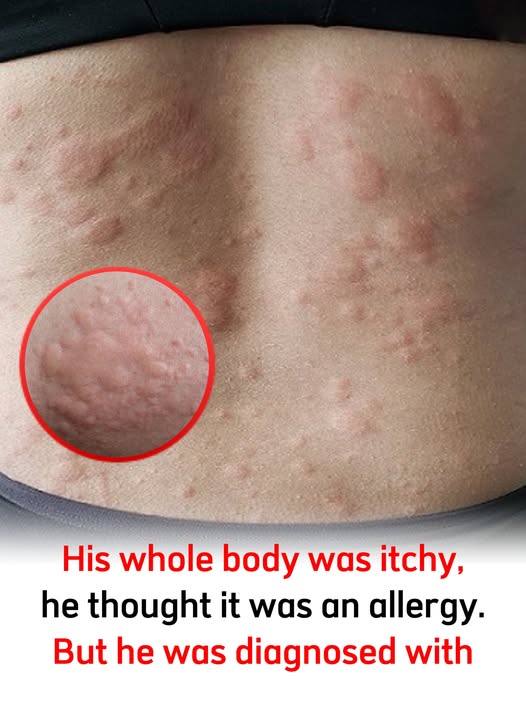 His whole body was itchy, he thought it was an allergy and was diagnosed.